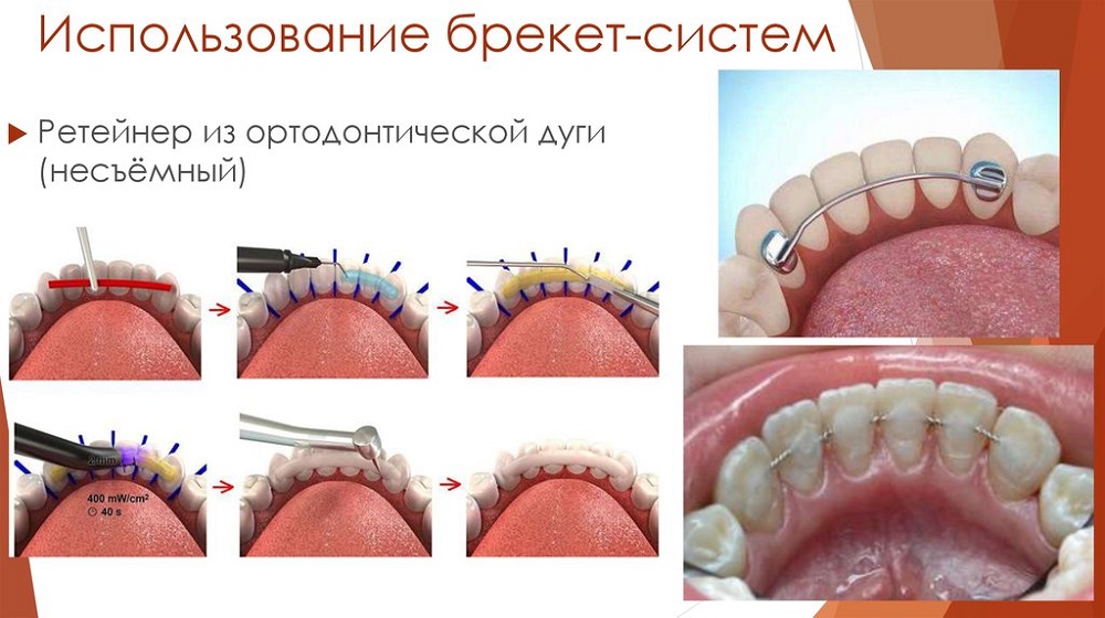 Презентация ортодонтические дуги